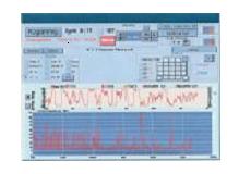 EEG Biofeedback (Flexyx Neurotherapy System)